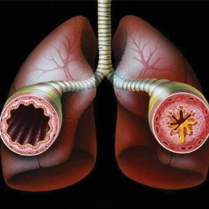 What are the features of small airway disease in AAV?