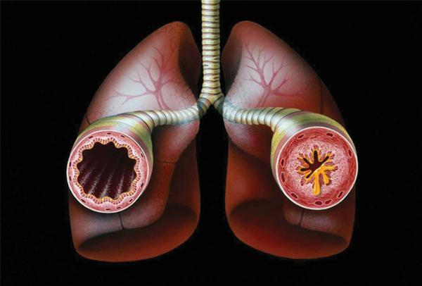 What are the clinical features of small airway disease in AAV patients?