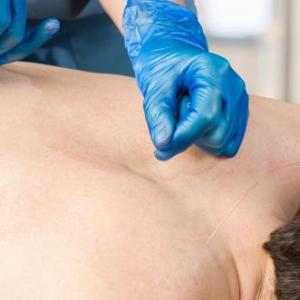 Acupuncture provides pain relief, functional recovery in lumbar spinal stenosis