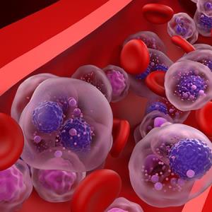 Myeloma patients may benefit from mezigdomide-dexamethasone doublet