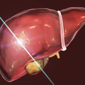 Microwave ablation: A better minimally invasive technique for HCC?