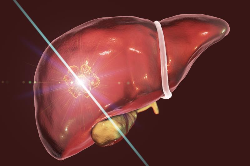 Microwave ablation: A better minimally invasive technique for HCC?