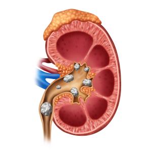 Age, depression linked to pain intensity following ureteroscopy for urinary stones