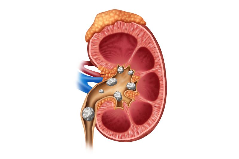 Age, depression linked to pain intensity following ureteroscopy for urinary stones