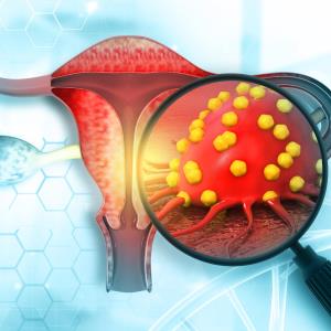 Lymph node characteristics predict survival in patients with ovarian cancer