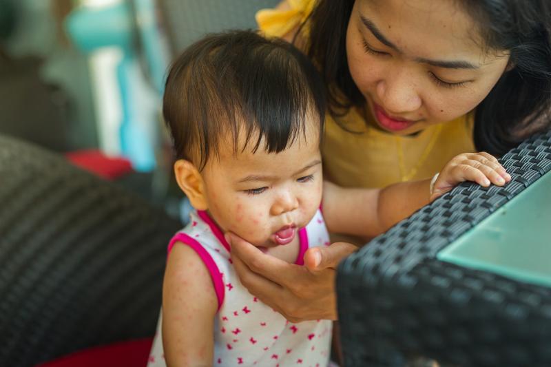 Admitted measles patients in Singapore present with vague symptoms