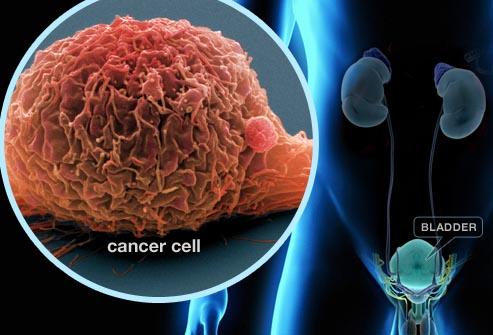 What is the ideal number of NACT cycles for muscle invasive bladder cancer?