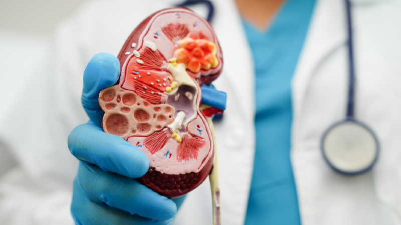 Evidence mounts for addition of SGLT2i to CKD
treatment regimen