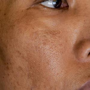 Revolutionising
hyperpigmentation treatment
with Melasyl