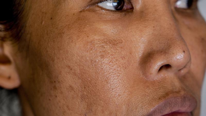 Revolutionising
hyperpigmentation treatment
with Melasyl