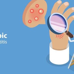 A holistic approach to atopic dermatitis:
Skin barriers, core therapies and adjunctive strategies