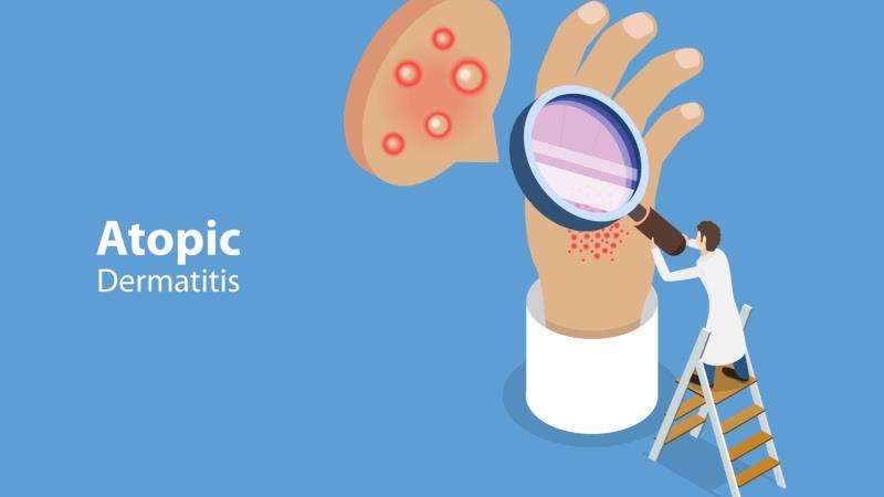 A holistic approach to atopic dermatitis:
Skin barriers, core therapies and adjunctive strategies