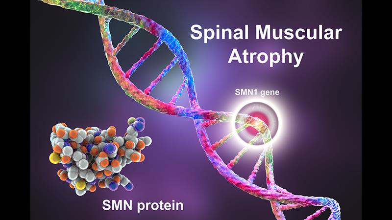 Management of paediatric patients with
spinal muscular atrophy by multidisciplinary
team of healthcare professionals