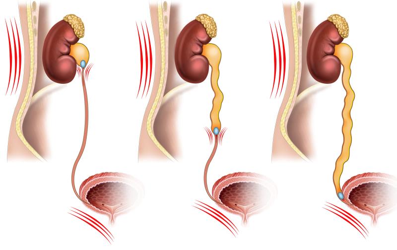 Most problems with flexible ureteroscopes attributed to surgeon error, inadequate maintenance