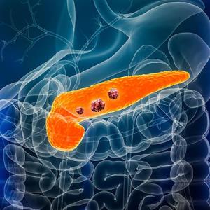 NALIRIFOX improves survival in older patients with mPDAC
