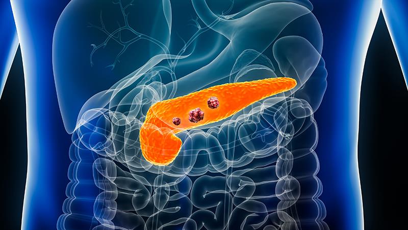NALIRIFOX improves survival in older patients with mPDAC