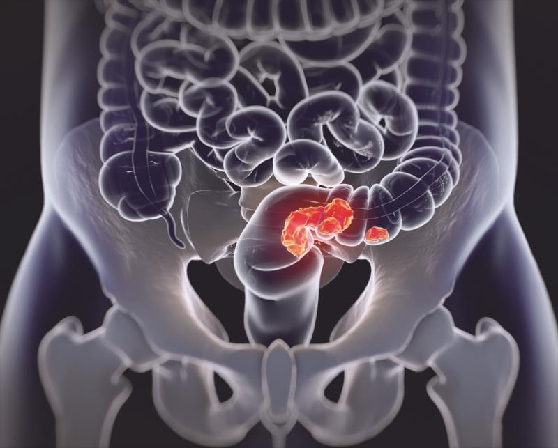 NAR score predicts prognosis in Chinese patients with locally advanced rectal cancer after neoadjuvant CRT