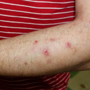 Nemolizumab alleviates skin symptoms in prurigo nodularis