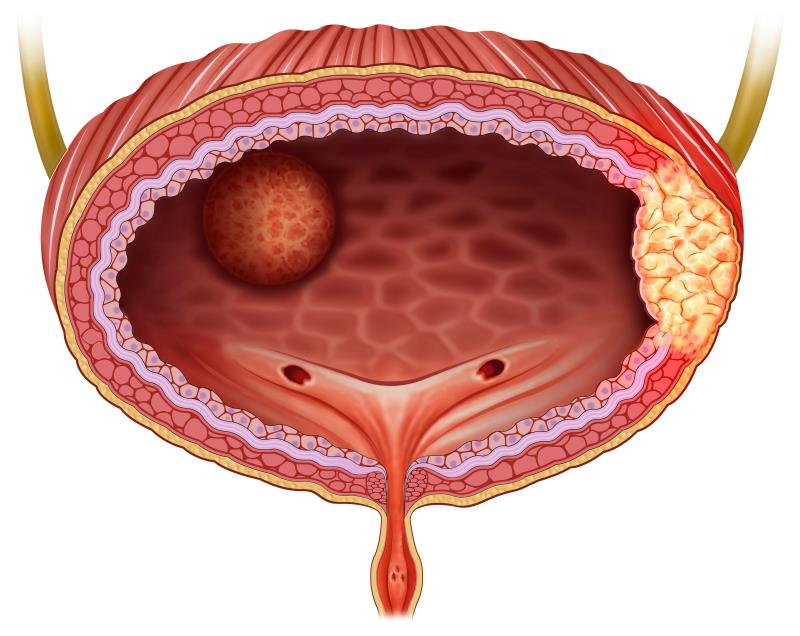 Androgen receptor expression tied to poor urothelial carcinoma outcomes