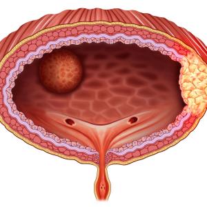 Squamous cell carcinoma of the bladder does not promote high-risk HPV