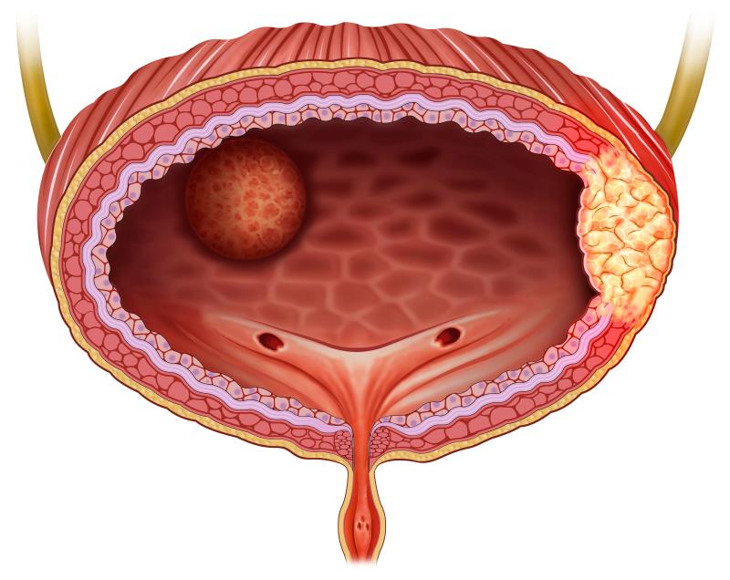 Tislelizumab plus nab-paclitaxel shows therapeutic potential against bladder cancer