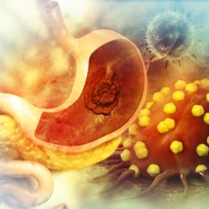 Tislelizumab–chemotherapy combo poised as new first-line option for advanced gastric cancer