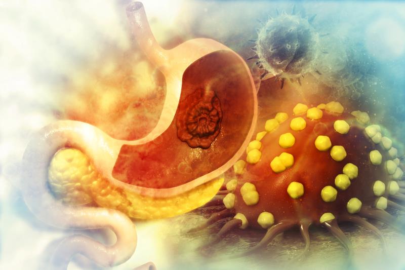 Tislelizumab–chemotherapy combo poised as new first-line option for advanced gastric cancer