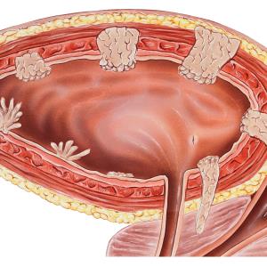 Nintedanib falls short in bladder cancer trial