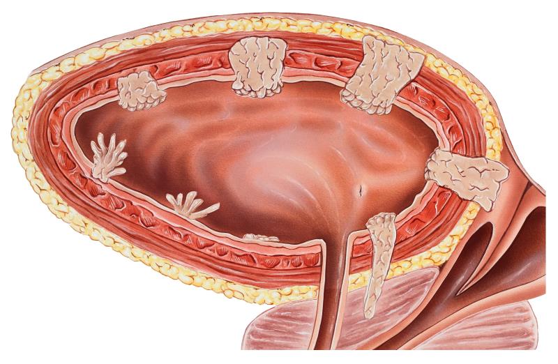 Nintedanib falls short in bladder cancer trial