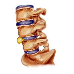 Can epidurals manage LDH-related sciatica?