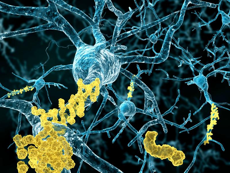 Many scientists believe that amyloids are key to the disease's effect on neurons