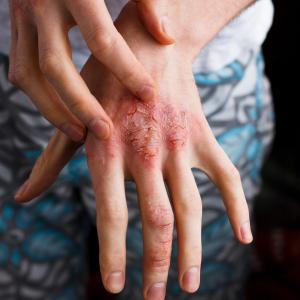 Severe atopic eczema ups mortality risk in adults