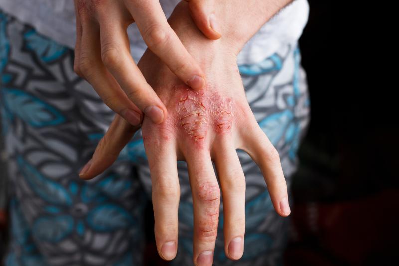 Severe atopic eczema ups mortality risk in adults