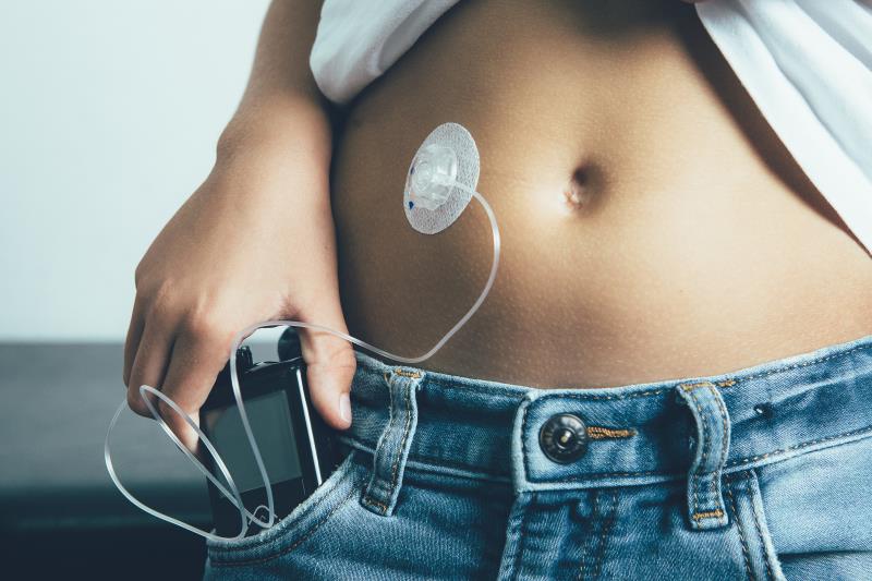 Automated insulin pump system does not alter energy, nutrient intake in T1D patients