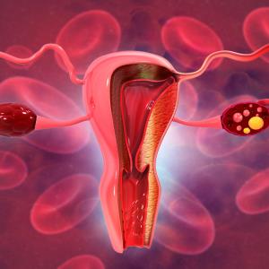 Niraparib improves PFS in Chinese patients with ovarian cancer