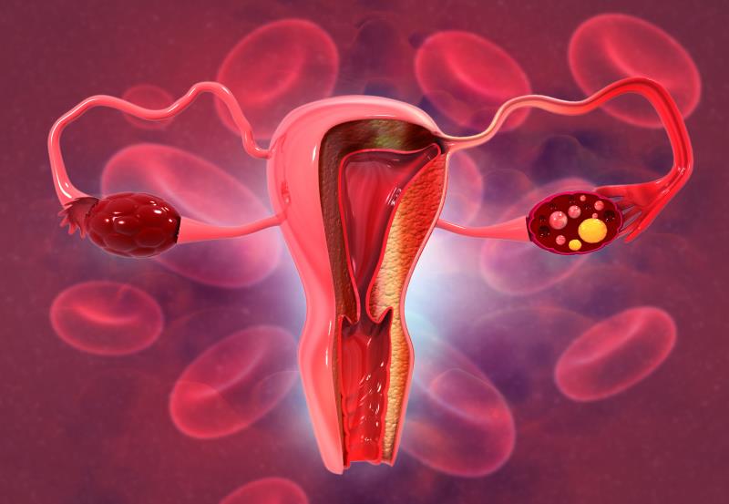 Trabectedin–durvalumab combo shows antitumour activity in refractory ovarian carcinoma