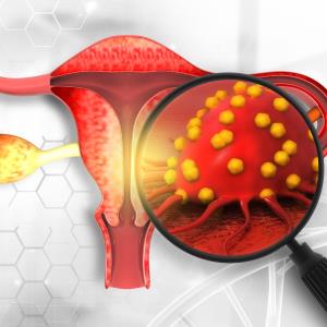 Niraparib maintenance prolongs PFS in advanced ovarian cancer