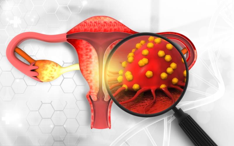 Niraparib maintenance prolongs PFS in advanced ovarian cancer