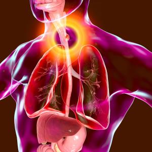 High- vs low-risk T1a EAC tied to more extraesophageal metastases