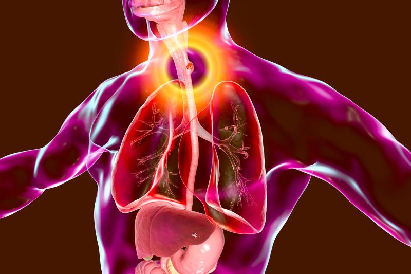 Perioperative chemo with FLOT confers survival advantage in esophageal cancer