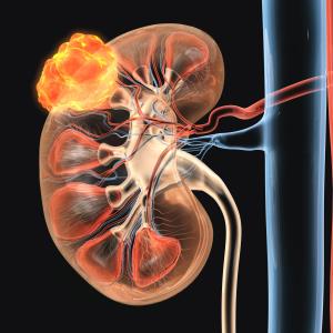 Nivolumab + cabozantinib combo offers better QoL in advanced RCC