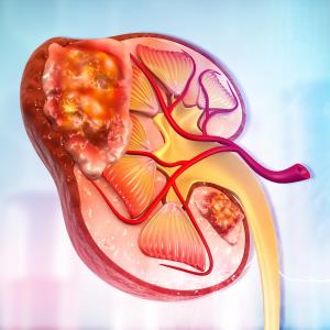 Nivolumab continues positive OS, ORR track record in advanced RCC