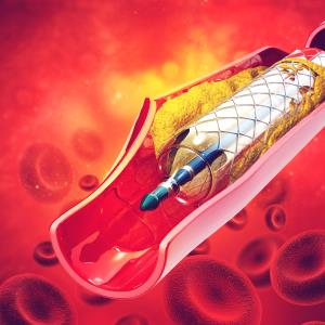 Bivalirudin safer than heparin in patients with chronic total occlusion