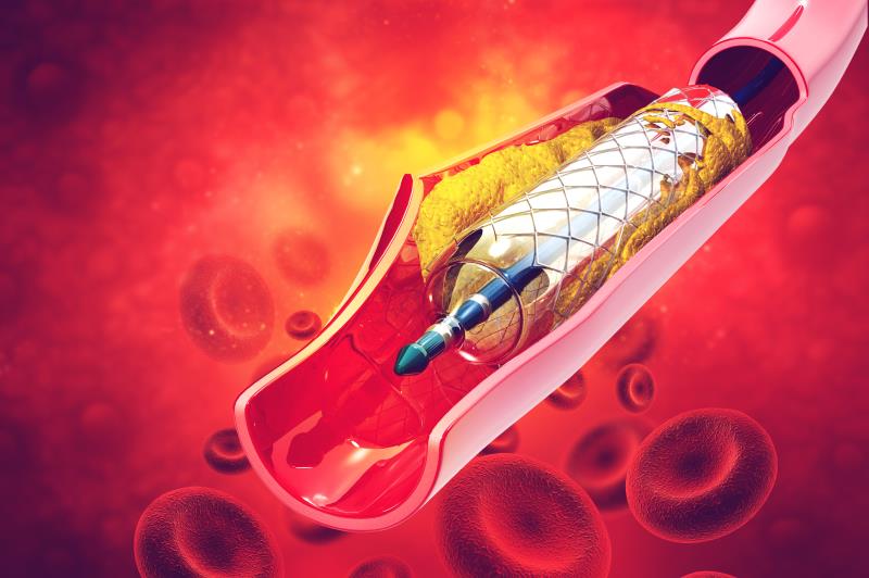 Bivalirudin safer than heparin in patients with chronic total occlusion