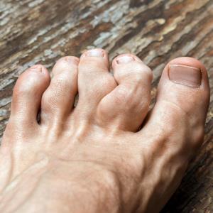 No excess CV risk with febuxostat vs allopurinol for gout: FAST study