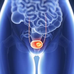 First-line durvalumab ± tremelimumab no rival to chemo in advanced urothelial carcinoma