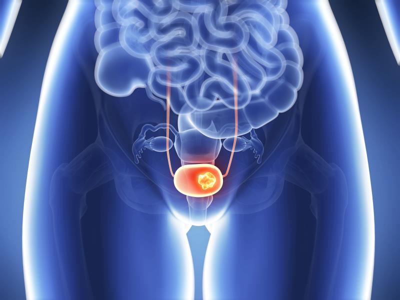 No OS benefit with first-line durvalumab ± tremelimumab in advanced urothelial carcinoma