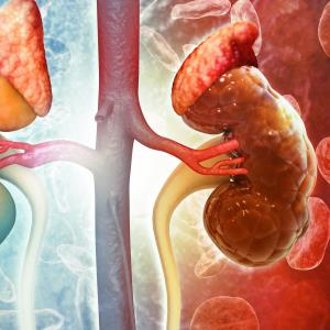 Does acute kidney injury lead to CKD progression?