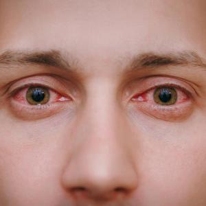 BRAF, MEK Inhibitors linked to ocular adverse effects