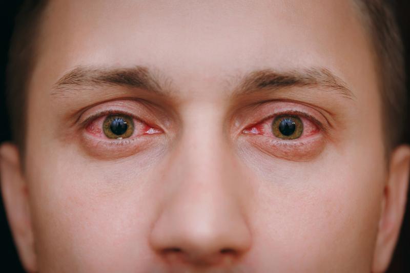 BRAF, MEK Inhibitors linked to ocular adverse effects